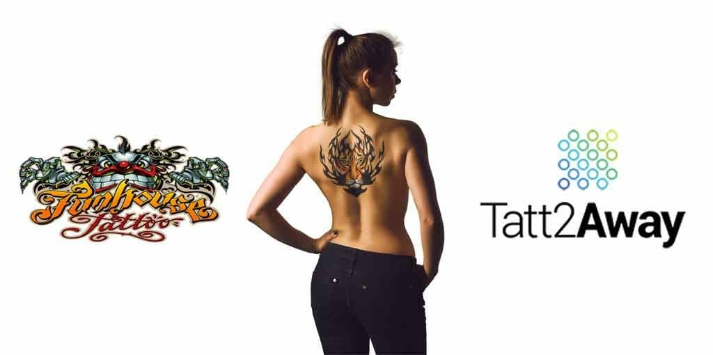 Sleeve Tattoo Removal Services by Tatt2Away