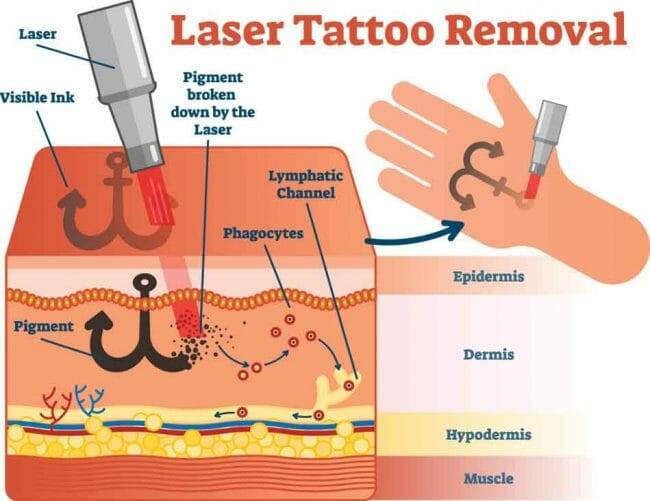 This image shows how the ink travels deeper into the body once being zapped by the laser. 